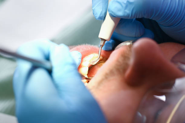 Best Emergency Root Canal Treatment in Somerset, TX