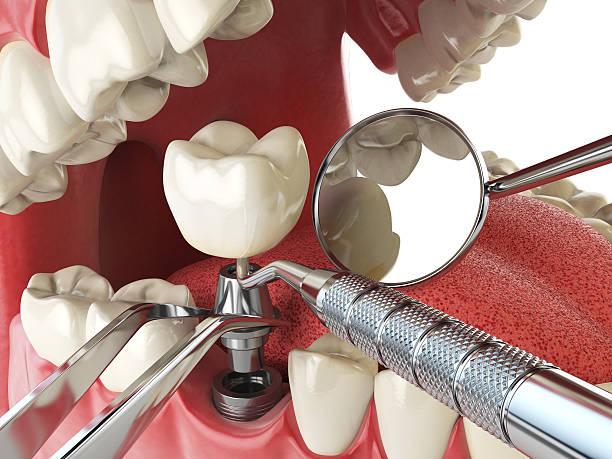 Best Emergency Dentist for Knocked-Out Tooth in Somerset, TX